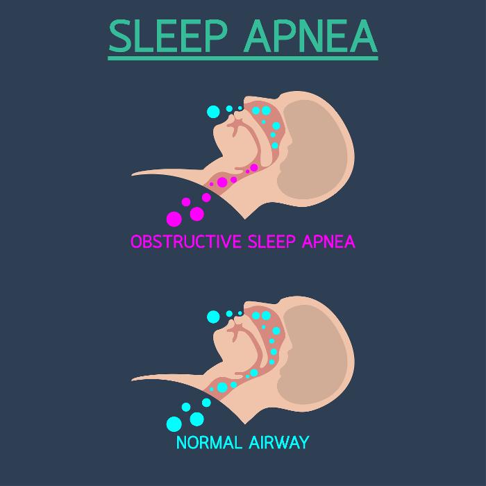 info graphic of sleep apnea patient | lakeville mn dentist