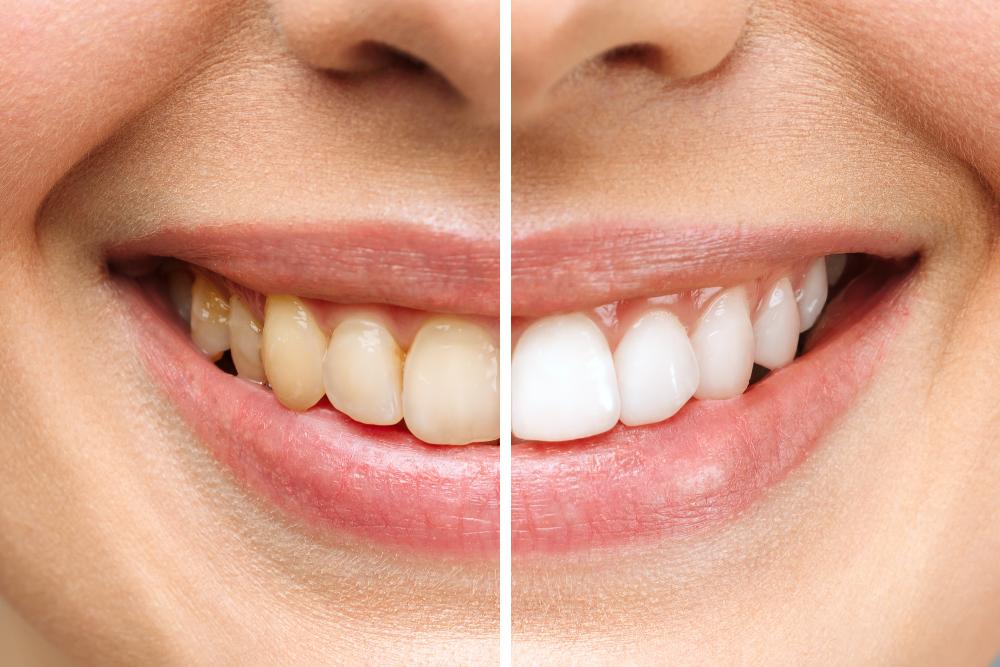 teeth whitening before and after | teeth whitening lakeville mn