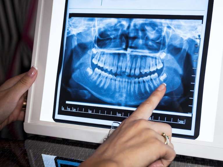 close up of panoramic x-ray | dentist office lakeville mn